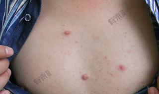 瘢痕疙瘩吧 瘢痕疙瘩吧